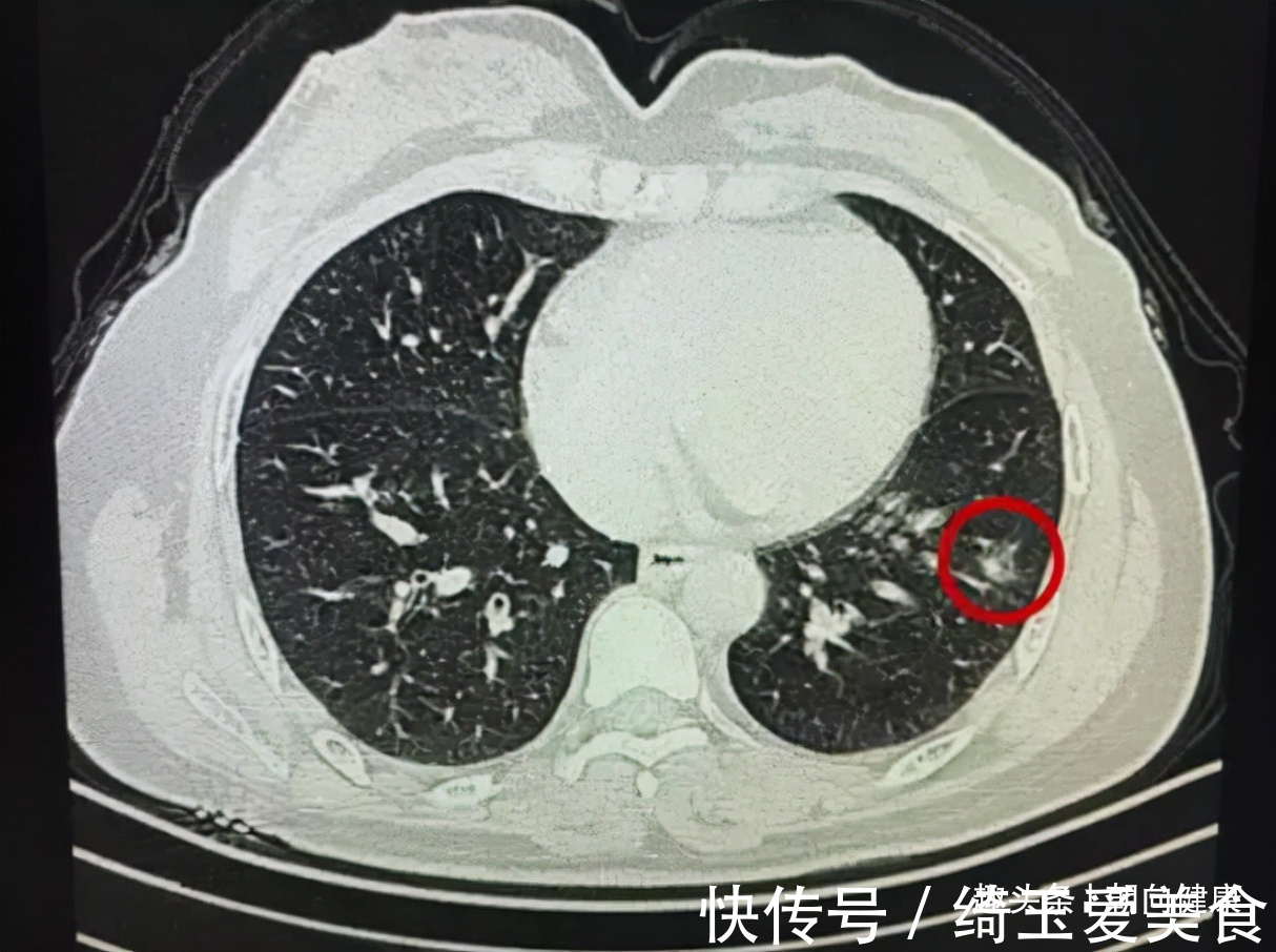 体检|体内有“结节”的人,5种“发物”要少碰,忍住不吃就是赢