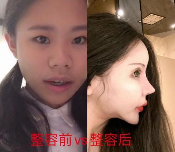 外貌|13岁女孩“整容上瘾”，3年整了60多次，如今“画风”不忍直视