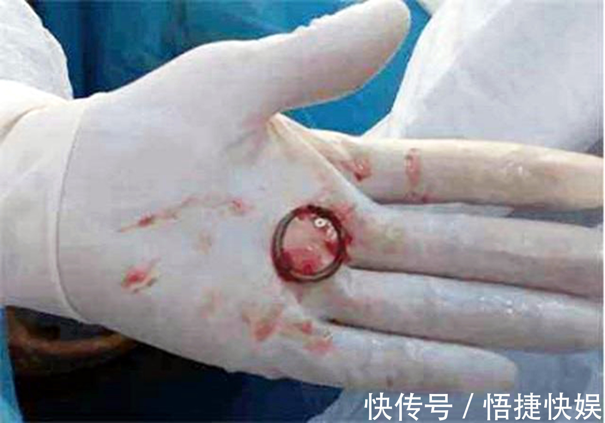 避孕|生一胎后上环,为生二胎取环,医生多亏生二胎的想法救了你