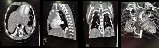 置针|做增强CT，为什么留置针的位置那么重要