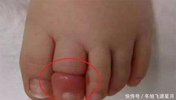 11月龄宝宝脚趾进“虫”,家长紧急送医,医生直言幸好来得早