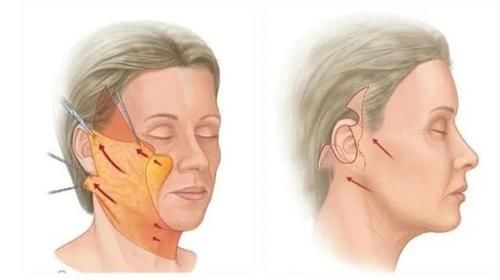 手术 拉皮手术只能维持3、5年？恢复期或许有些痛苦，医生有话说