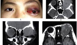 肿瘤|眼眶也会得癌症!眼球突出视力下降要当心!