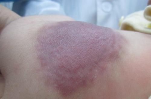 色素|孕期这些行为,会给你的孩子带来“印记”,孕妈可别忽视