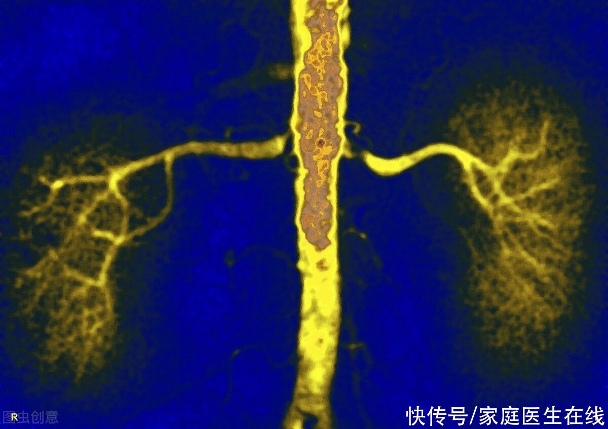 危害|肾结石不治疗会怎样？5个危害会找上门，后果不是说笑的