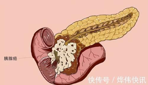 肺癌|医生坦言：最不希望患者碰到3种癌，发作前毫无征兆，要早作预防