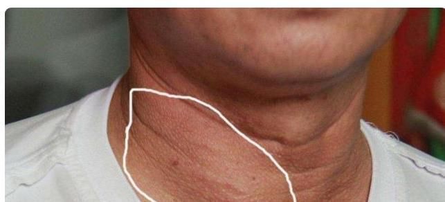 蒲公英|甲状腺结节“天敌”或被找到，每天喝点，结节走远远