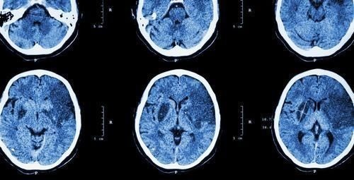 脑血管|睡觉出现4个异常,说明脑血管堵了,做好4个字,清血脂通血管