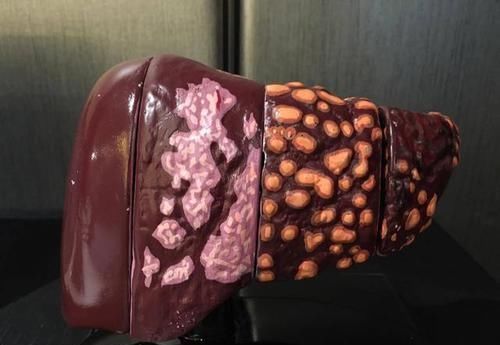 肝脏CT|肝癌是酒“泡”出来的?两个部位很臭,最好去检查一下肝脏CT