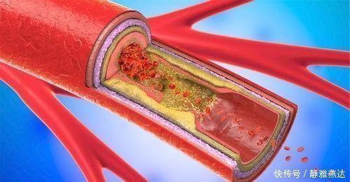 高血糖|糖尿病,最可怕的是并发症!牢记3方法,让血糖高的人远离并发症