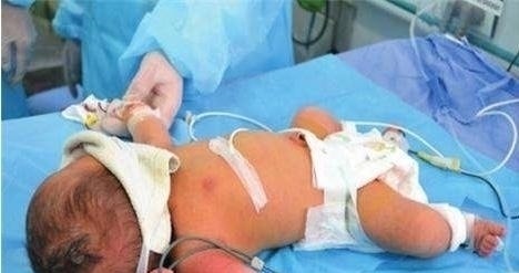 胎儿|孕妇错把胎儿求救信号当做调皮，胎儿剖出来时，傻眼了