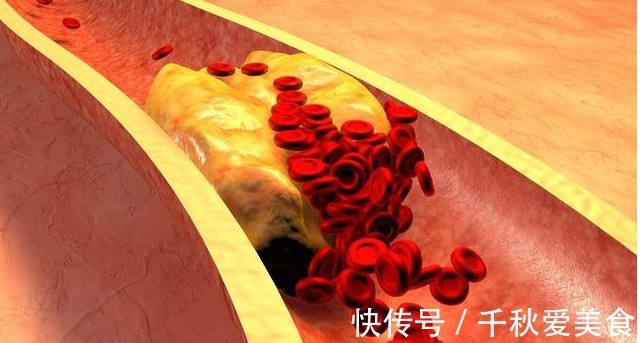粘稠度|血脂高不高，看头就知道，若没有4种症状，恭喜，血管还算通畅
