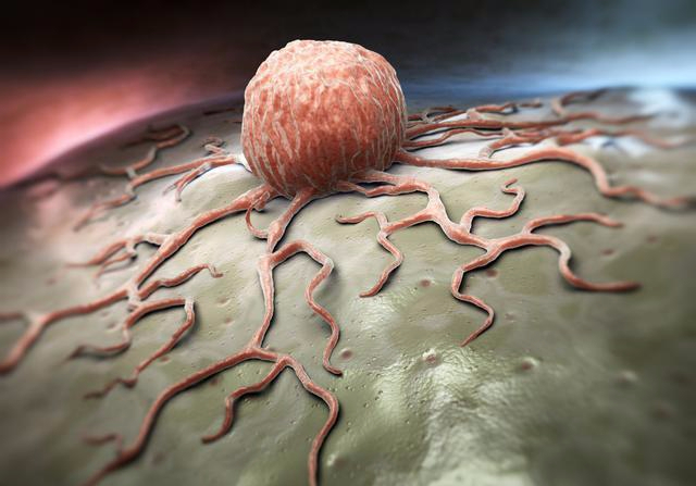 肺结节|体检查出结节、息肉、囊肿，哪个才是癌症前兆帮你做了3个分析