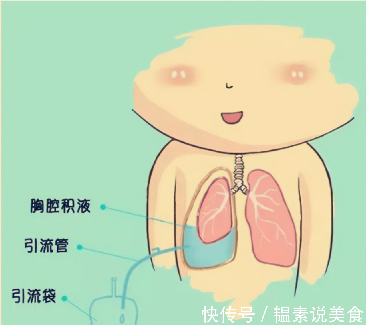 胸水|看中醫效果顯著而忽視病情，發現腫瘤已是晚期，治療后復發咋辦