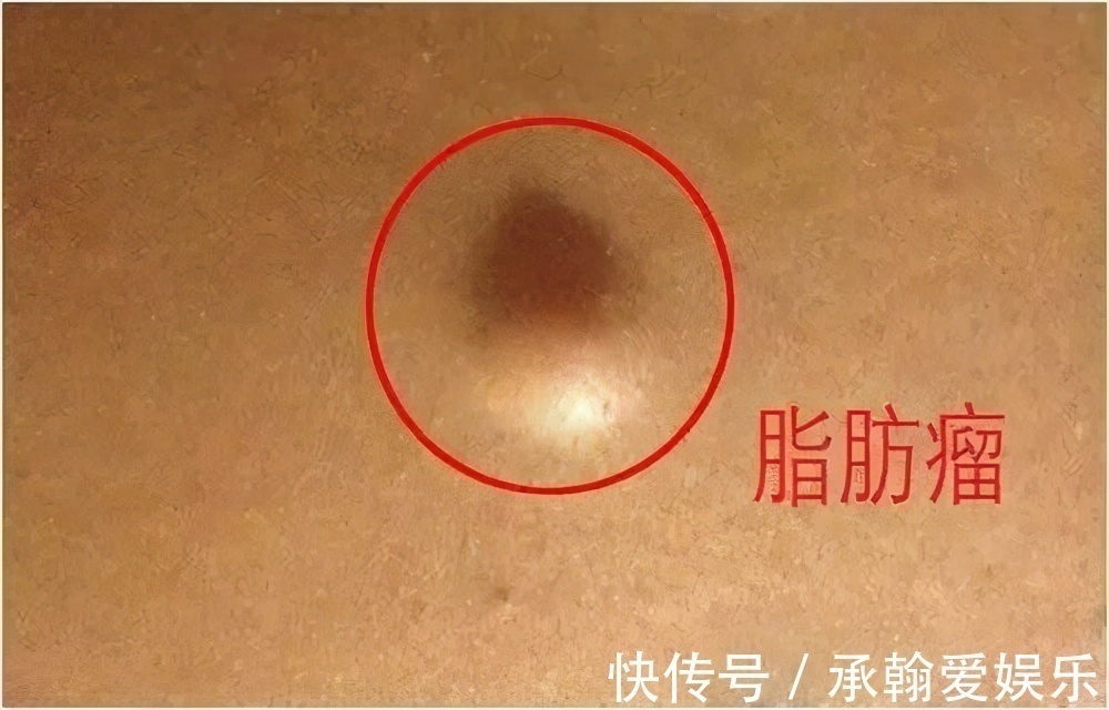 脂肪瘤|这3种瘤都是良性病变,医生提醒一旦查出来,不必自己吓自己