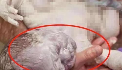 雪人|产妇生下“雪人”，丈夫崩溃不想养这娃，医生却笑开了花恭喜