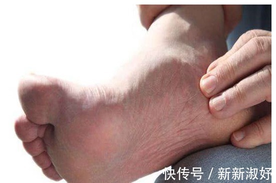 癌细胞|有没有癌，“腿”知道，若有以下3种异常，也许是癌细胞来访