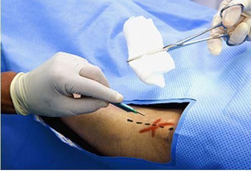 记号|偷偷给病人肚皮上画了一个圈，避免了外科医生被大佬骂惨