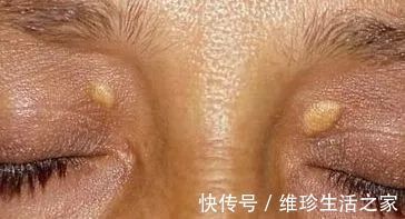 莱菔子|55岁女子高血脂入院,医生:一旦皮肤这3个处“亮起红灯”,请及时检查