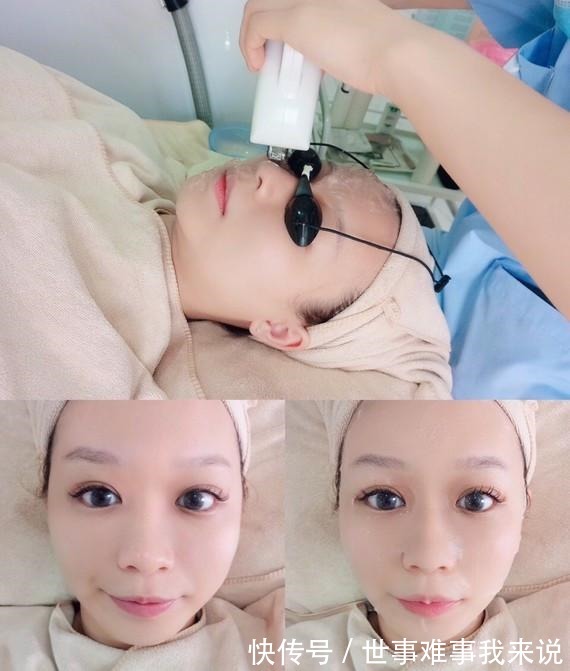 光子嫩肤 光子嫩肤这么选!效果好还省钱!光子嫩肤这么选!效果好还省钱!
