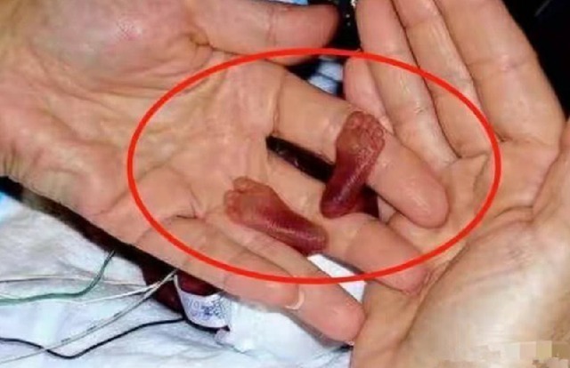 孕妇|还记得世界上“最小婴儿”吗?网友都期待她长大模样,如今她来了