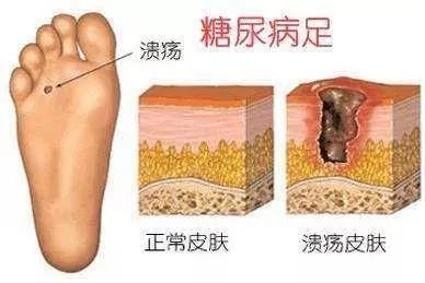 患者|糖尿病足严重的可截肢，九类人群一定要重视