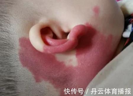 祸根|胎记长在哪里最有福气?恕我直言,2种胎记长哪都可能是祸根