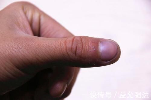 患者|癌症患者,用靶向药物,对身体有何影响?提早了解,更好应对