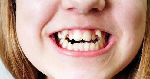 宝妈|儿子因“口臭”被同学嫌弃,带孩子检查,取出来的颗粒果然很臭