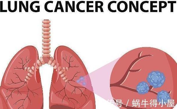 疼痛|34岁的妇女患有皮疹,身体检查发现患有肺癌,因为忽视了一些变化