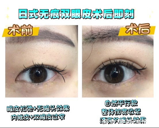 眉眼|上海九院孙沣博士:如何拥有自然好看的双眼皮?