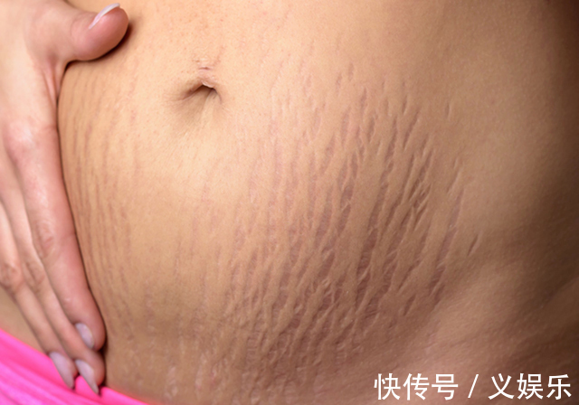 孕妈|怀孕后,为啥有人会长妊娠纹,有人却不会长和这四个因素有关