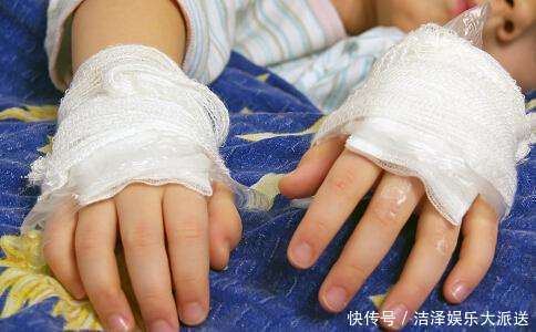 伤情|孩子被烫伤后该先冲水还是先脱衣服这一步错了,可能伤情会更重