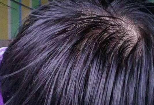 专家|头发爱出油,究竟是福是祸?专家给出了“正解”!