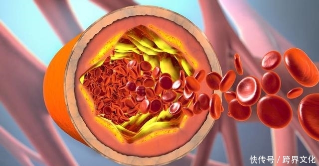 动脉硬化|预防骨质疏松,这1个水果就可以解决,但这4个字能做到的人不多