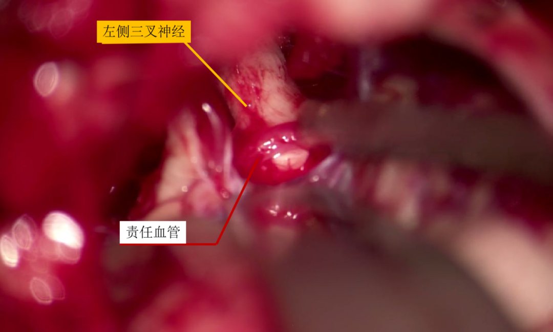 血管|微血管减压术治疗颅神经疾病的经验与体会