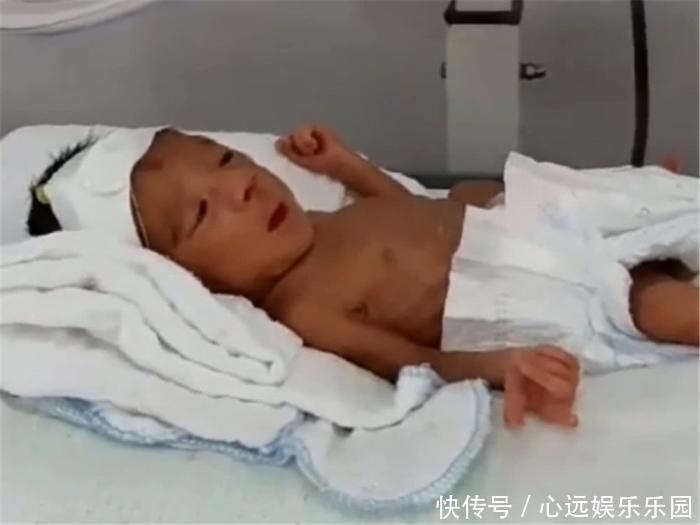 宝宝|重900克的早产儿,第一次见妈妈就笑了,宝宝的腿却让妈妈泪崩
