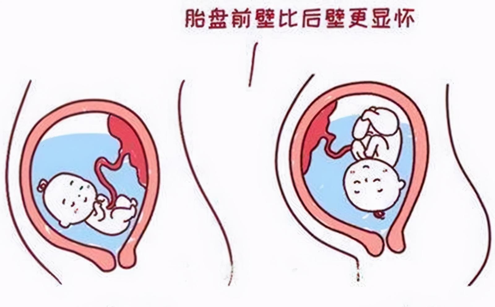 胎盘|怀孕两个月,肚子像其他人怀孕四个月一样,是什么原因?