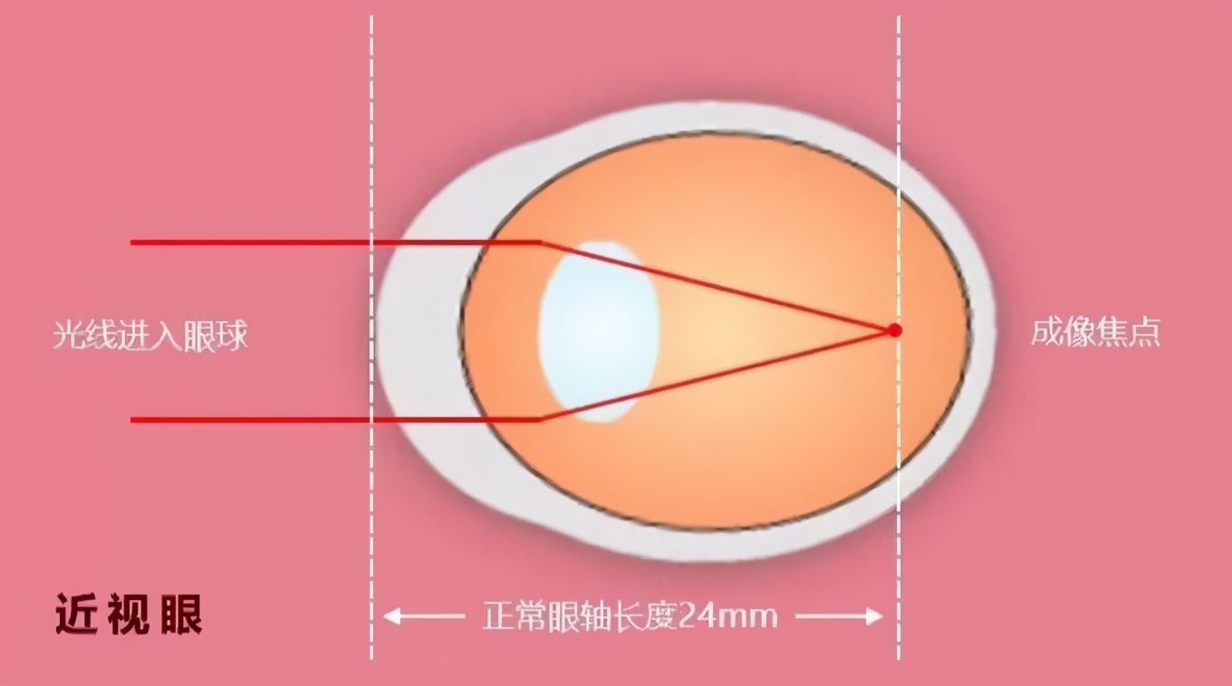  眼睛|这个数值孩子用完就会近视？