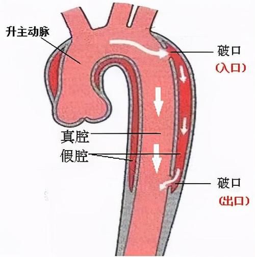 旋风|旋风杀手，主动脉夹层是什么病？