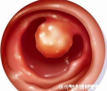 平胃散|一个只有四味药的中药方,能消除一切息肉,值得你收藏!