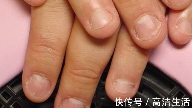 肝炎|指甲是肝脏的晴雨表,出现3种异常,说明可能肝炎又重了