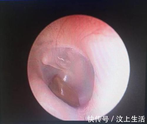 孩子|2岁女童在游乐园突然抠耳朵，连送4家医院，取出的东西让父母崩溃