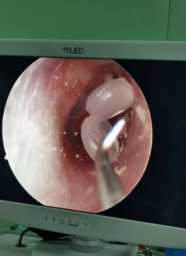 医生|5岁男孩竟往耳朵里塞这个全麻后才取出,医生紧急提醒