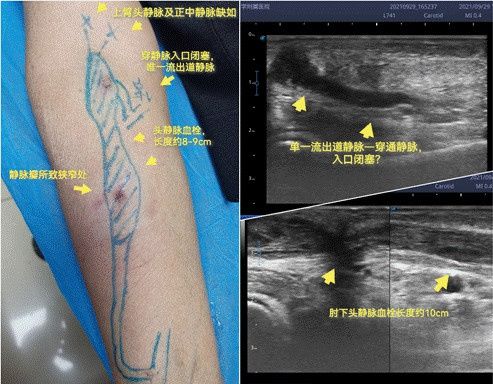 静脉|为保正常透析医院为孤寡老人开通失功内瘘