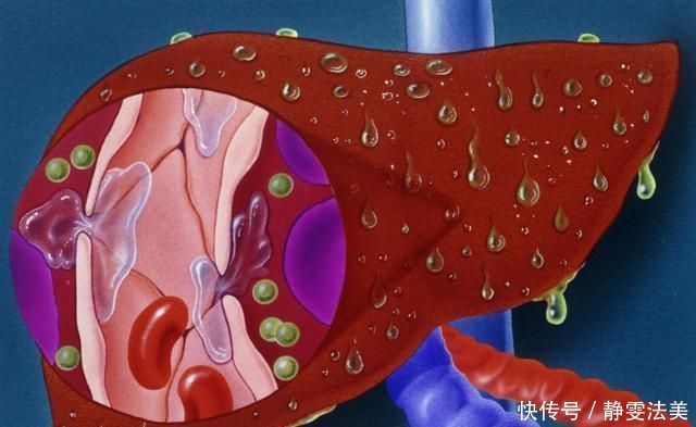 晨起若有这4个迹象，或是肝脏已“变硬”，劝你早做肝CT，别忽视