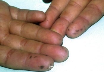 莱菔子|55岁女子高血脂入院，医生：一旦皮肤这3个处“亮起红灯”，请及时检查