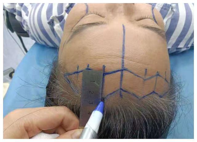 面部 51岁小拉皮术后1个月,我想跟大家说点真心话
