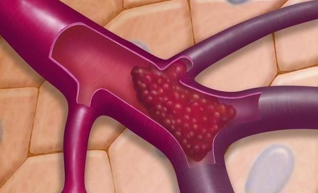 血管堵塞|心内科医生：血栓最怕1个动作，每天坚持20秒，让血管重获新生！