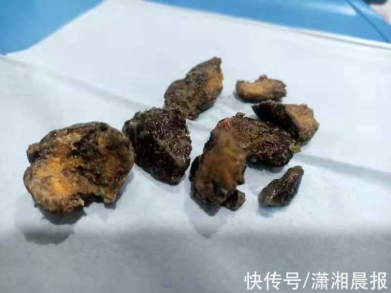 胃结石|73岁老人胃里长巨大结石，竟是贪吃柿子惹的祸